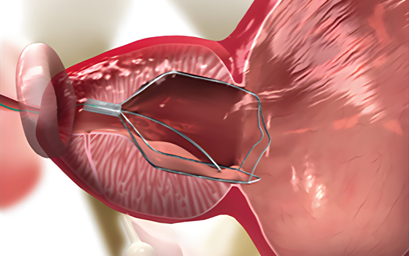 스텐트 설치 일러스트