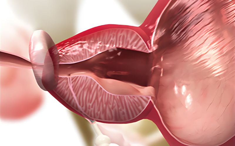 스텐트 제거 일러스트