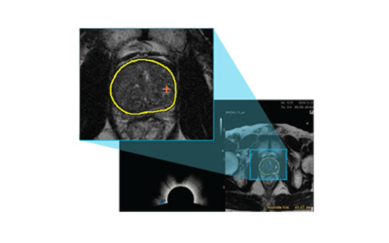 전립선 MRI 영상 화면