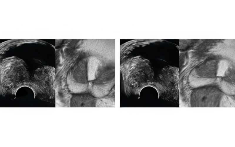 전립선 변형 조정 화면