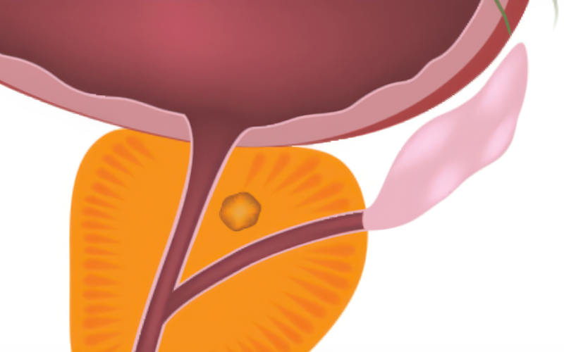 국소성 전립선암 일러스트