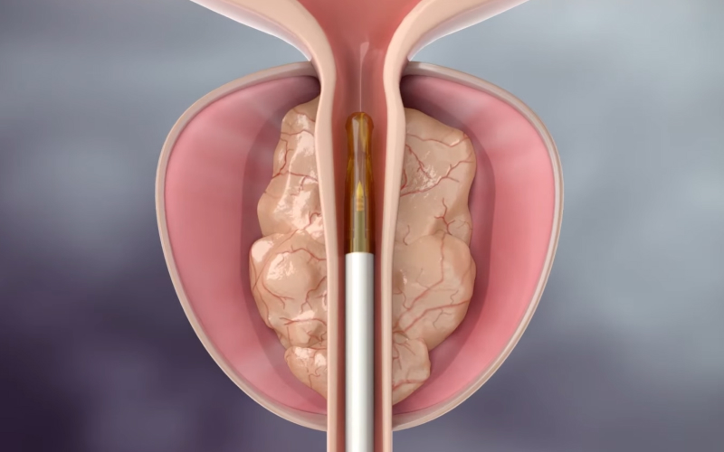 내시경 삽입 일러스트