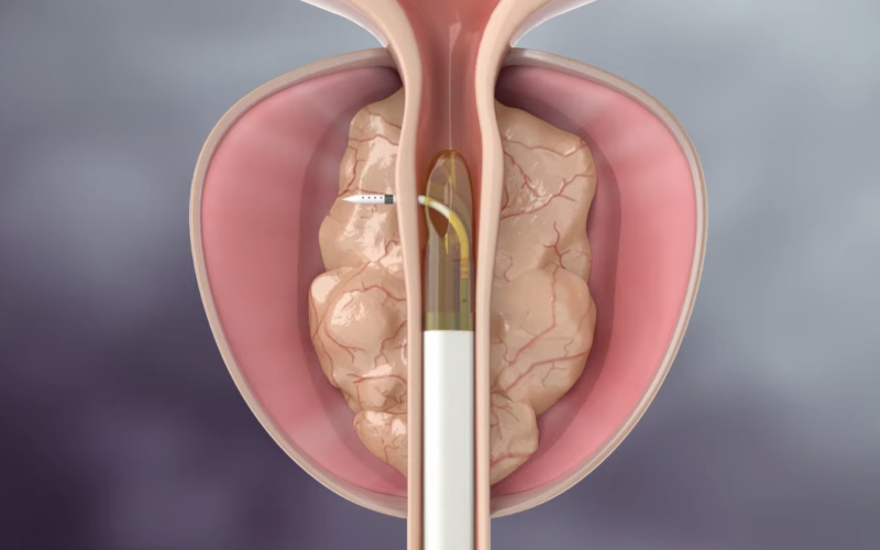고온 수증기 주입 일러스트