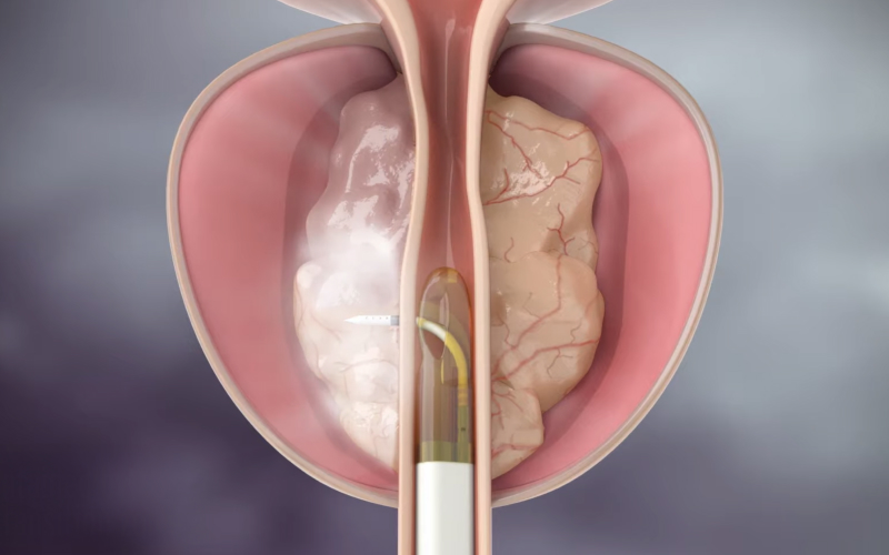 전립선 비대 조직 축소 일러스트