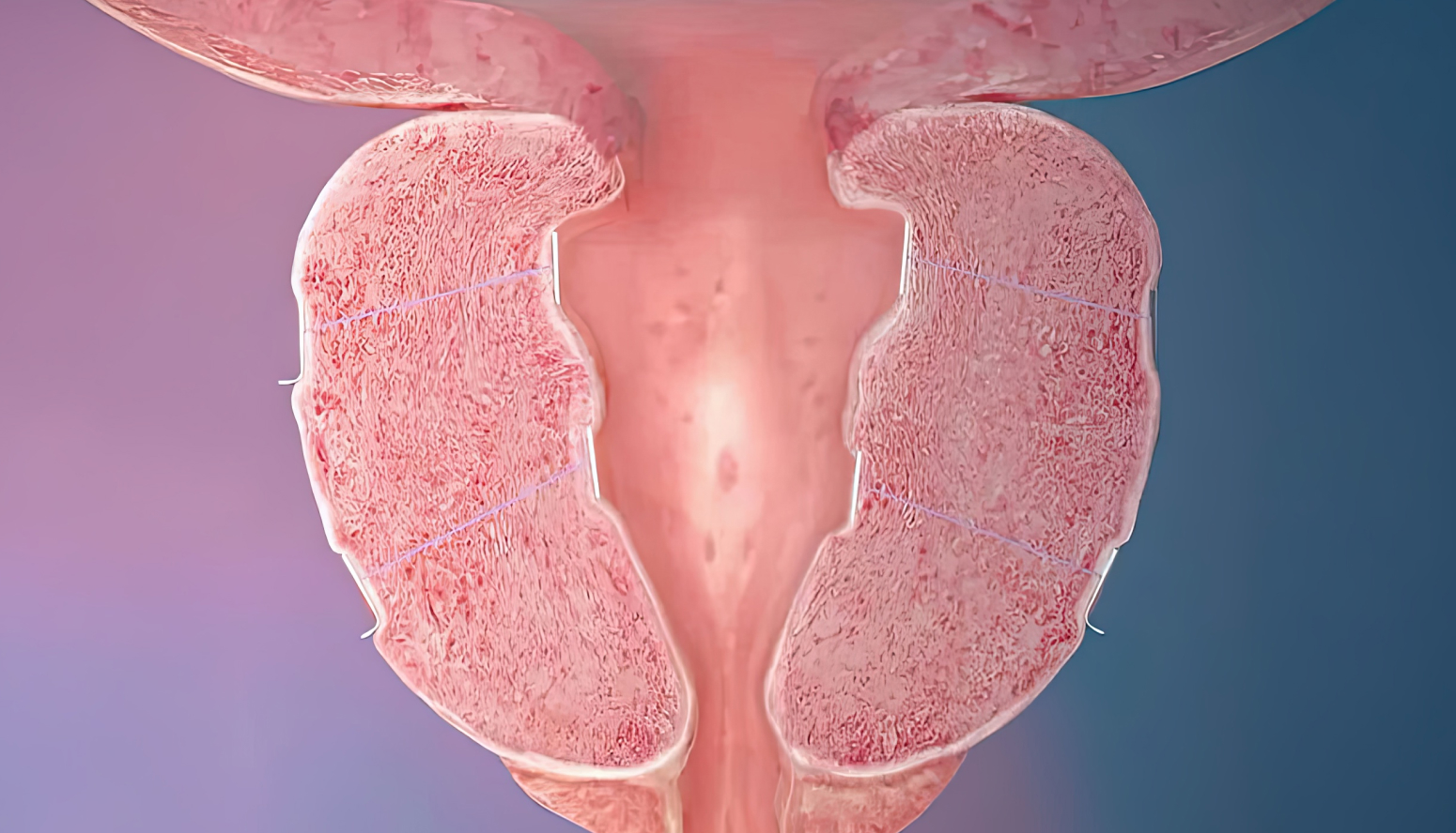 유로리프트 수술 후 전립선