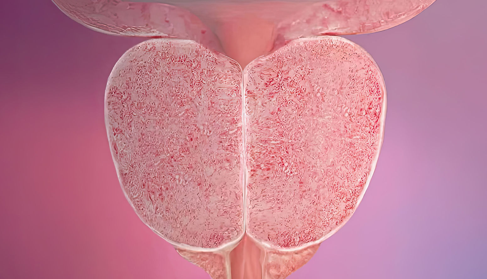 유로리프트 수술 전 전립선