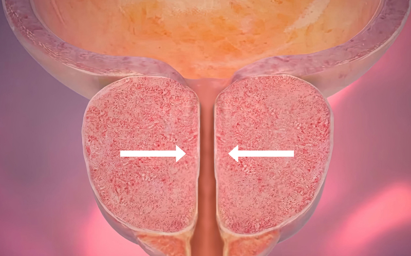 요도를 압박하는 전립선 일러스트
