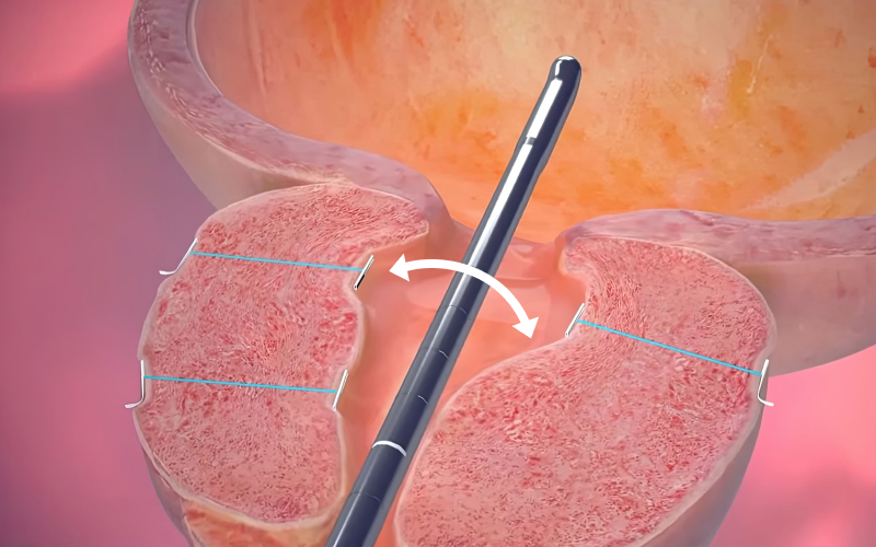 전립선 조직 고정 일러스트