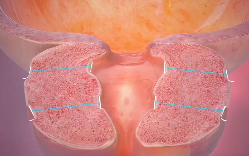 요도 통로가 확보된 전립선 일러스트