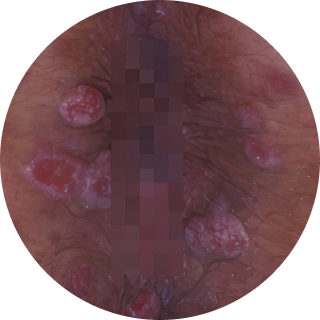 편평 사마귀 예시