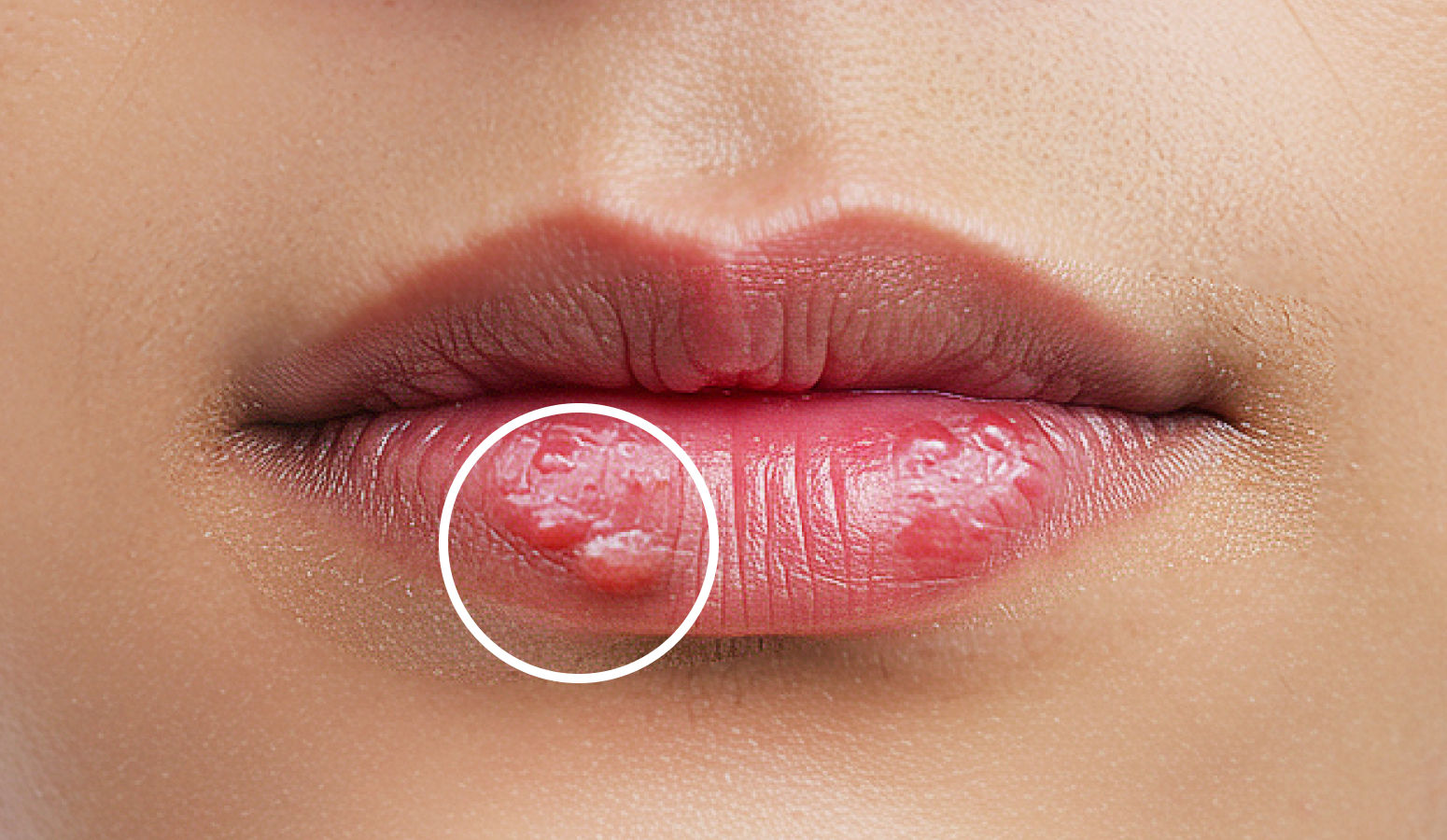 입술에 수포가 난 모습
