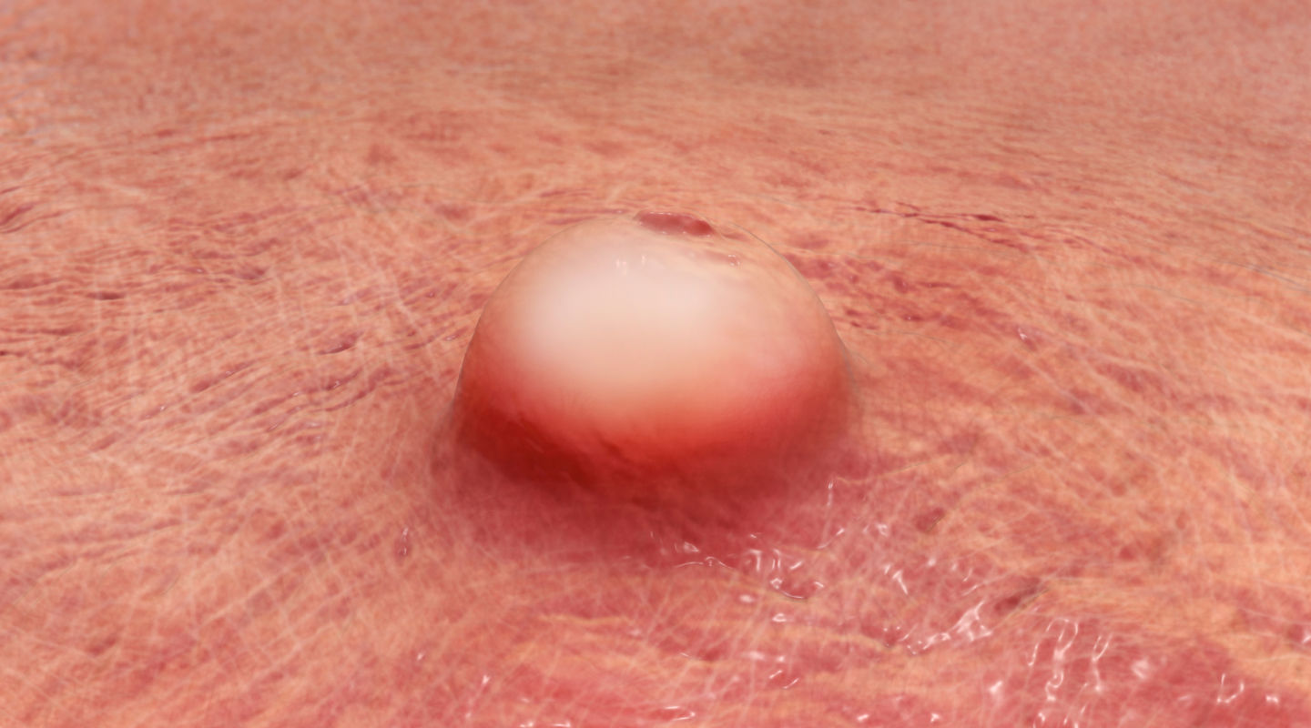 성병성 림프육아종 일러스트