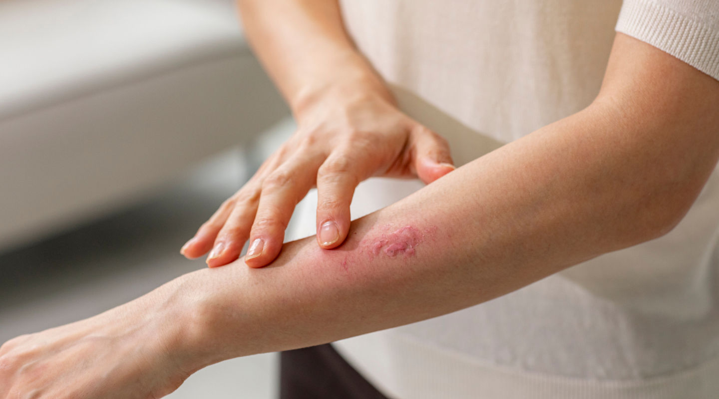 팔에 올라온 옴