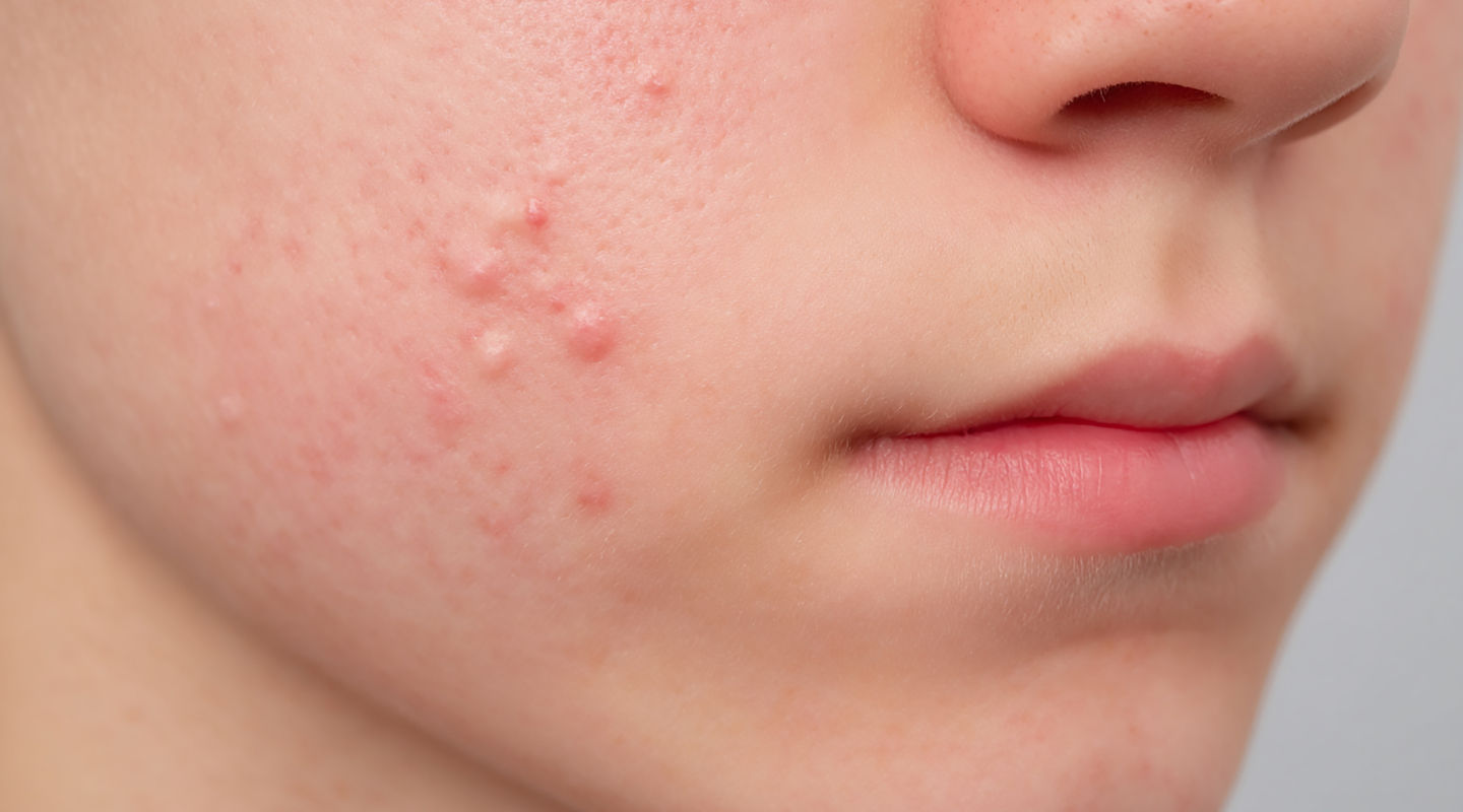 볼에 올라온 전염성 연속종