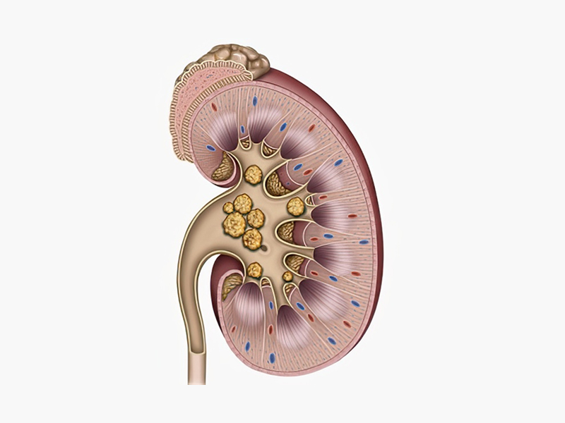 결석이 생긴 신장 일러스트