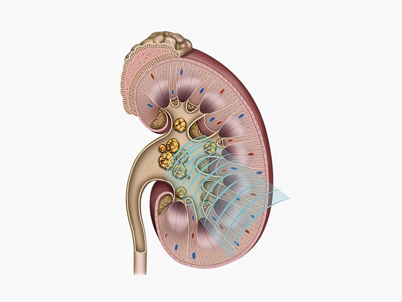 충격파 치료 일러스트