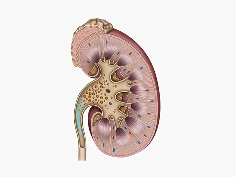 결석이 배출된 신장