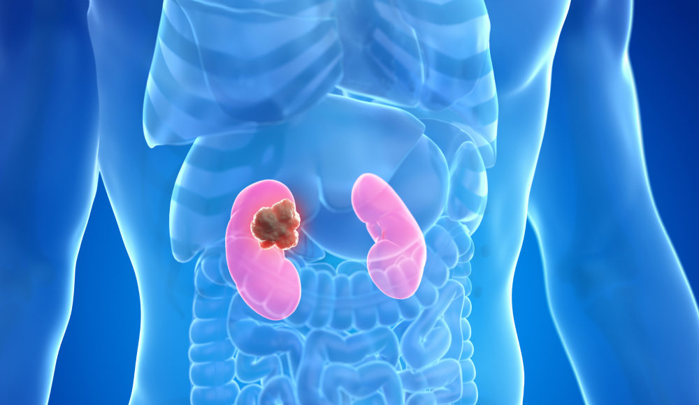 신장결석 3D 일러스트