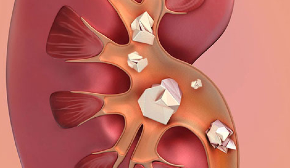 다결석 일러스트