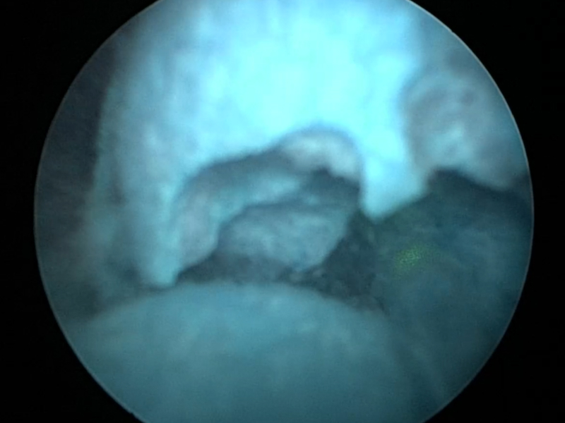 신장 내부 내시경 화면