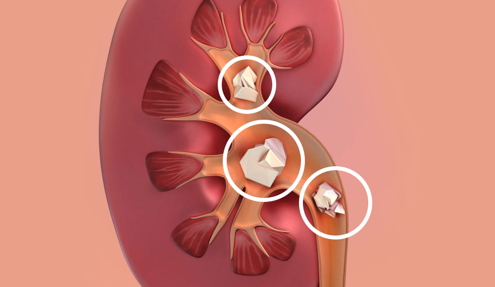 다발성 결석 일러스트