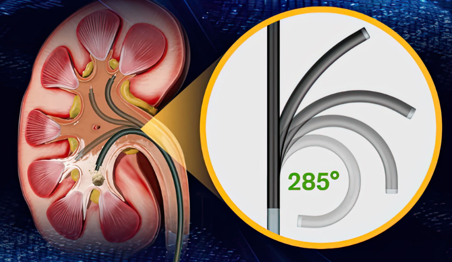 흡입형 요관내시경수술