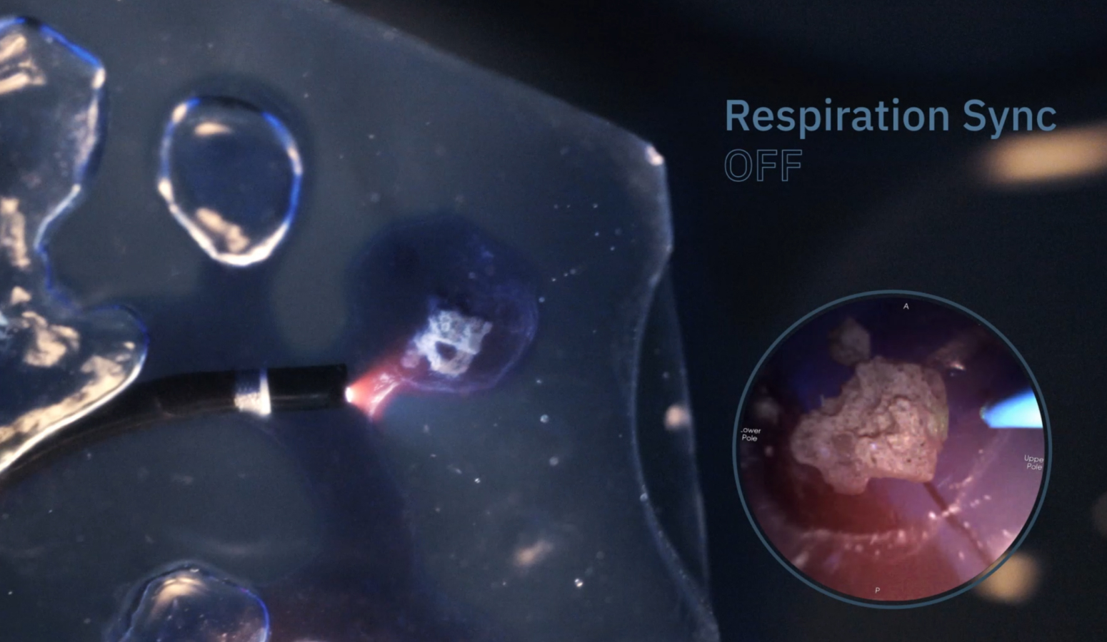 자메닉스 수술 화면