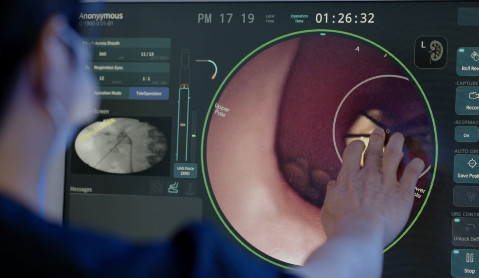 AI 수술 설계 화면