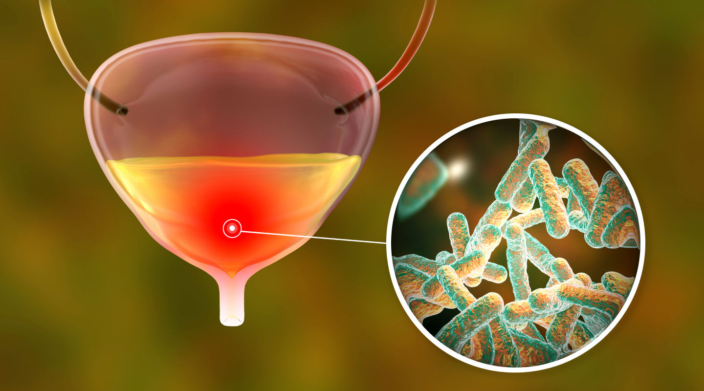 방광과 대장균 일러스트