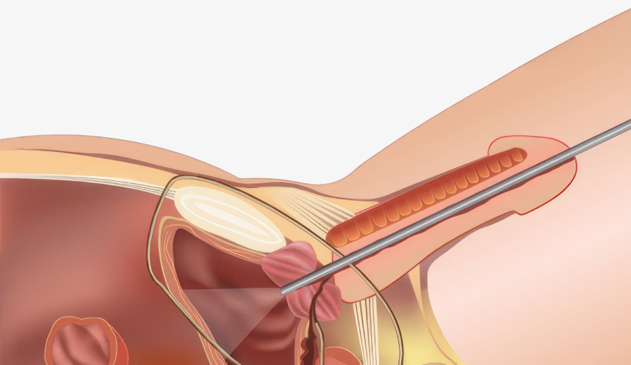 방광 내시경 검사 일러스트