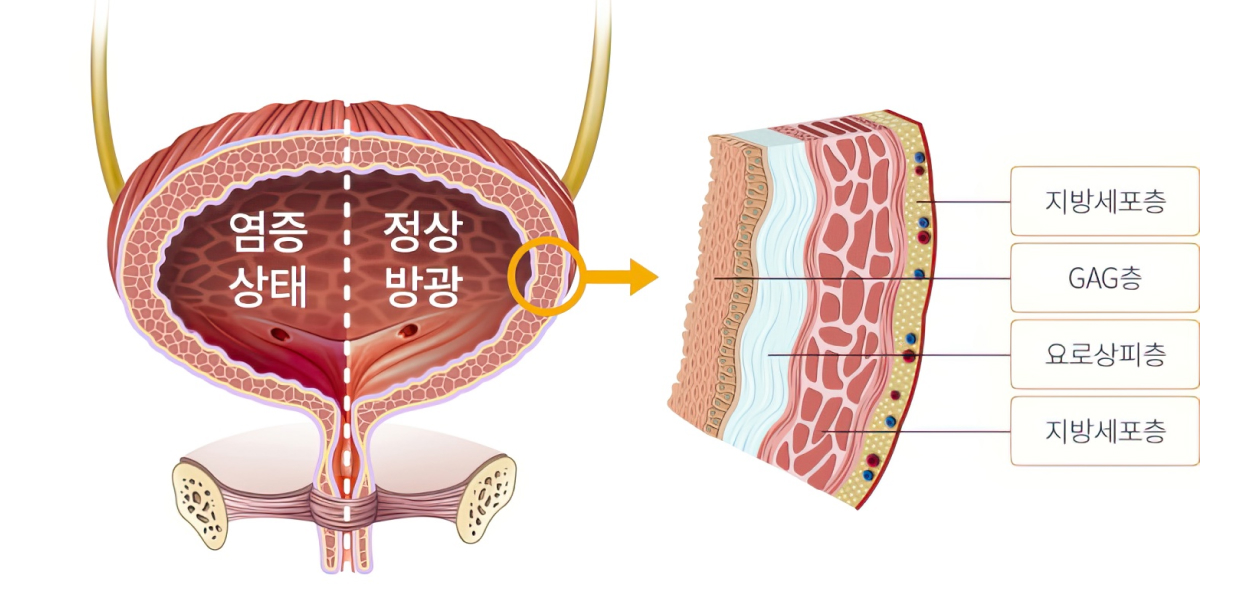 정상 방광과 간질성 방광 차이 일러스트