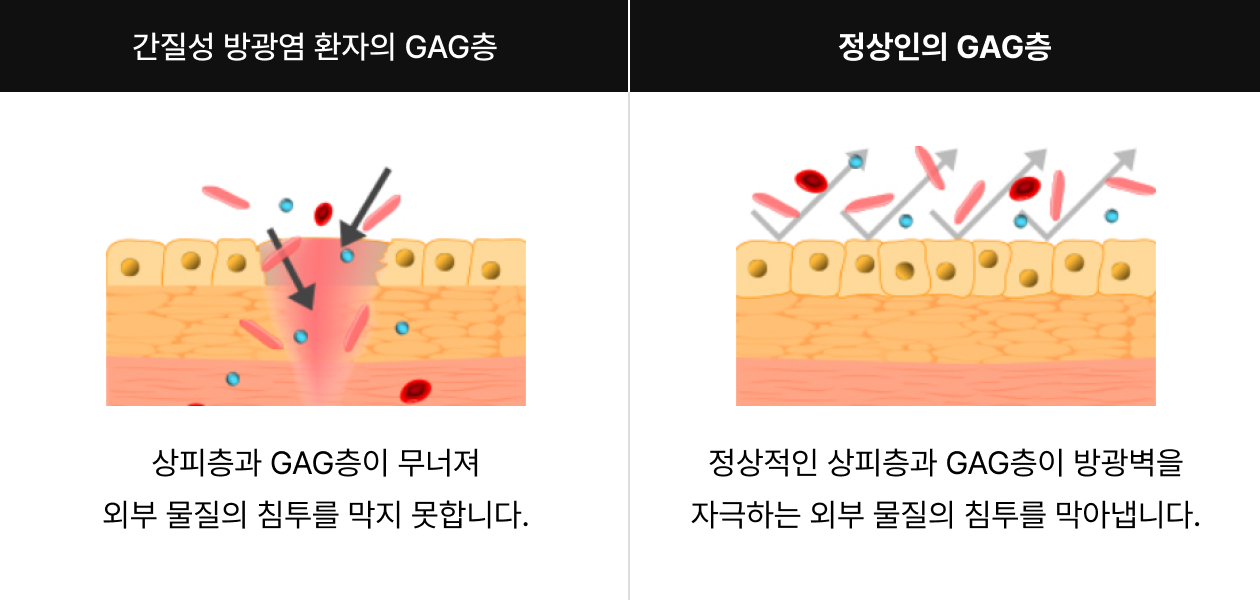 간질성 방광염 환자와 정상인의 GAG층 차이