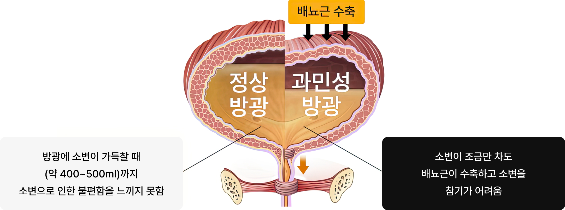정상 방광과 과민성 방광 차이 일러스트