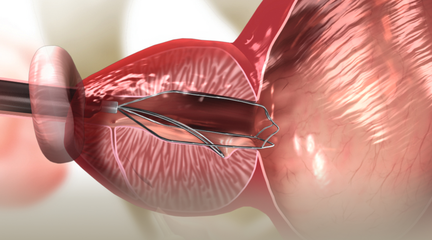 아이틴드 삽입술 일러스트