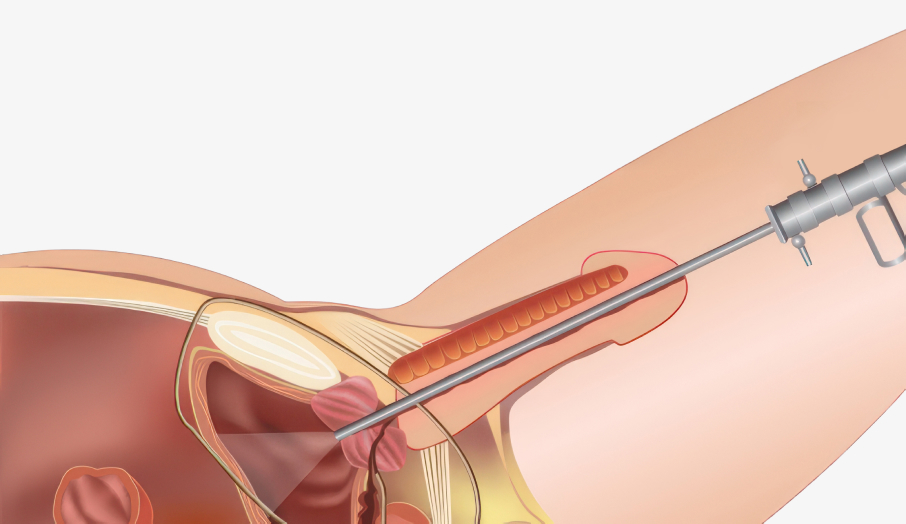 요도·방광 내시경 검사 일러스트