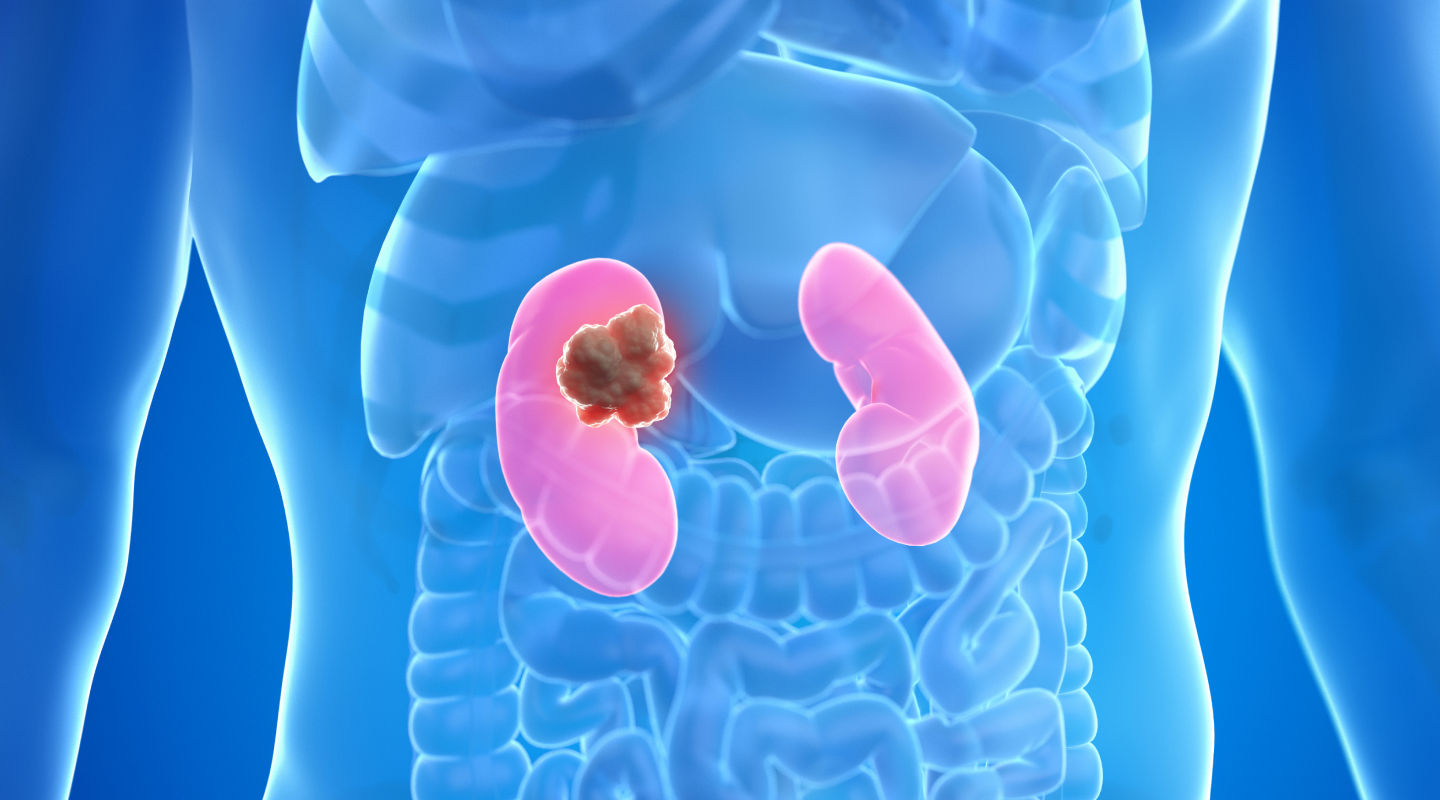 신낭종 3D 일러스트