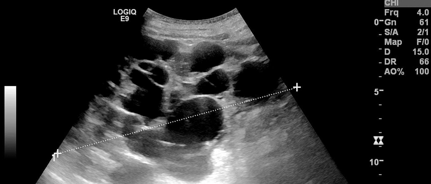초음파 결과 화면