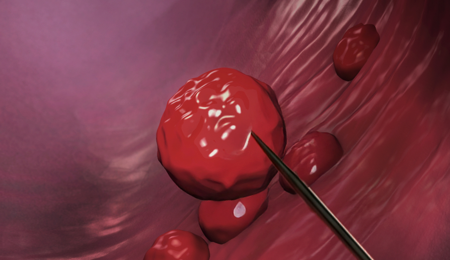 경피적 낭종 배액술 일러스트