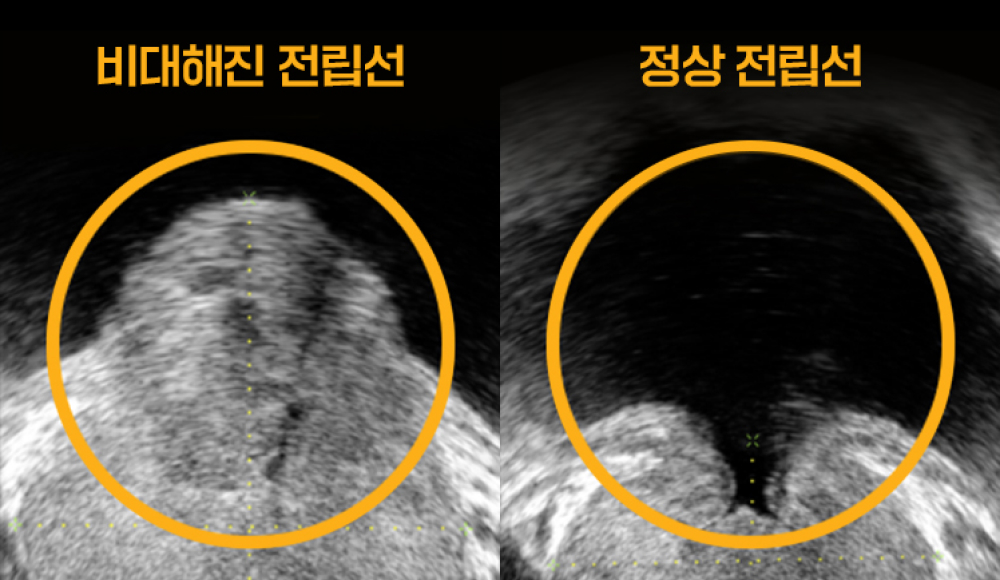 정상 전립선과 비대해진 전립선 비교