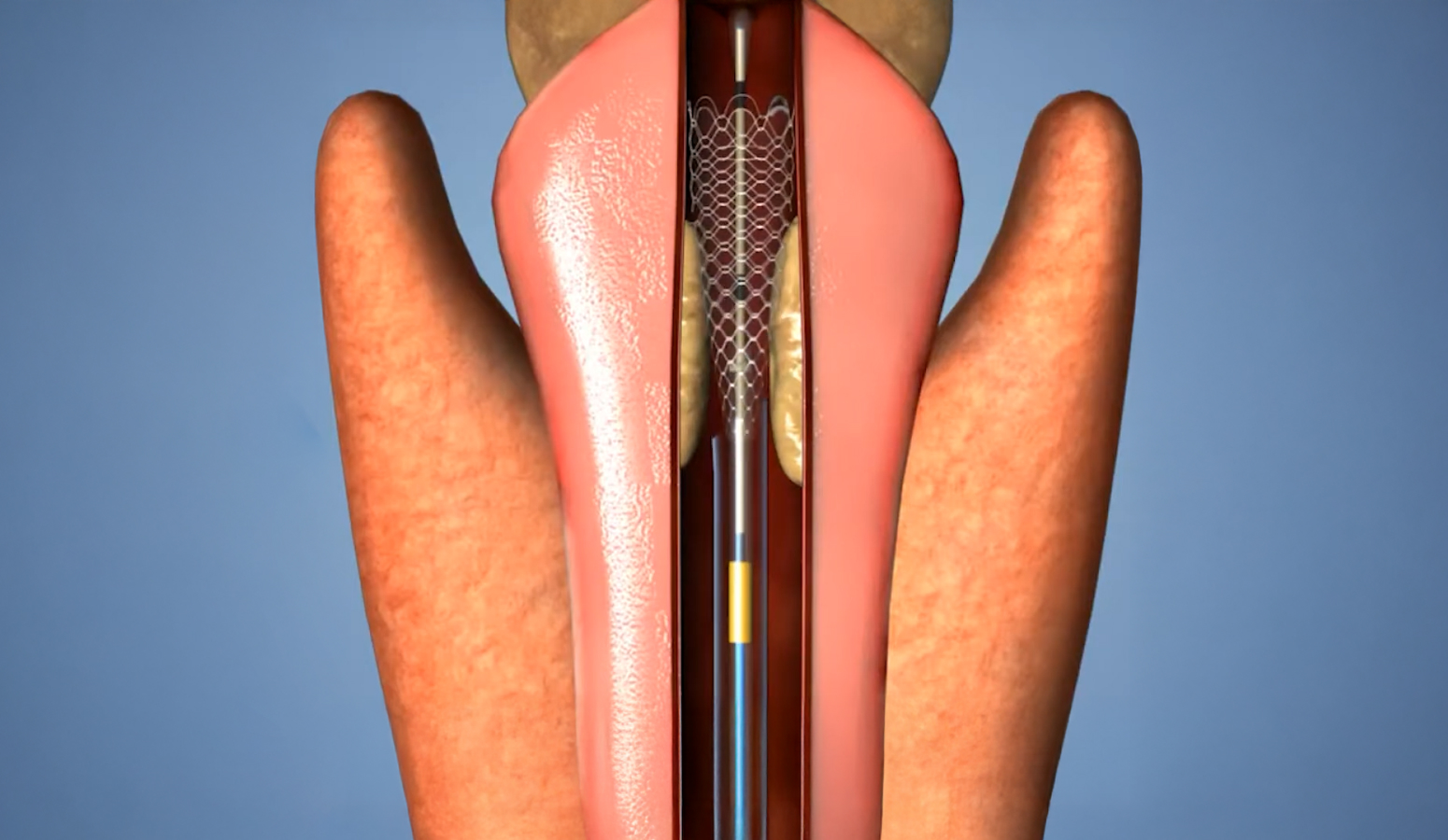 요도 스텐트 삽입술 일러스트