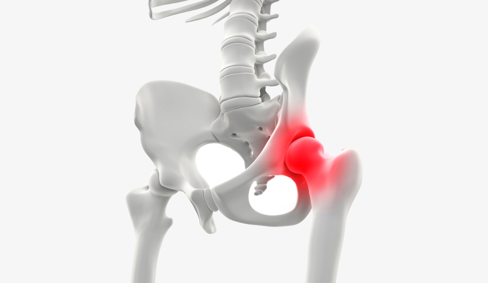 골반 골절 일러스트