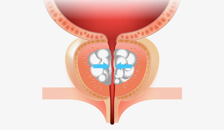 전립선비대증 일러스트